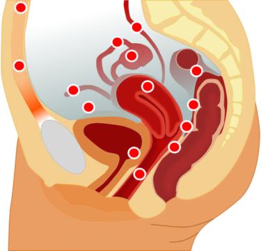 Some of the locations where endometriosis can be found in the pelvis (CC BY-SA 3.0)