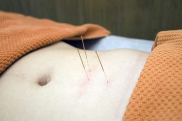 A person's exposed stomach with orange towels covering above and below has three acupuncture needles protruding from it. 