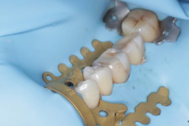 A rubber dam cut to fit tightly around five teeth and helt in place with metal guards.