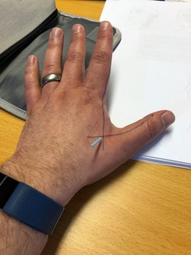 A hand with lines drawn on it and an acupuncture needle between the thumb and index finger