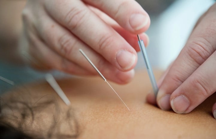 Acupuncture needles in a patient - note that the practitioner is not wearing gloves (Photo by Katherine Hanlon on Unsplash)