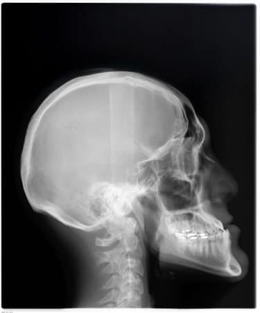 X-ray of a human skull