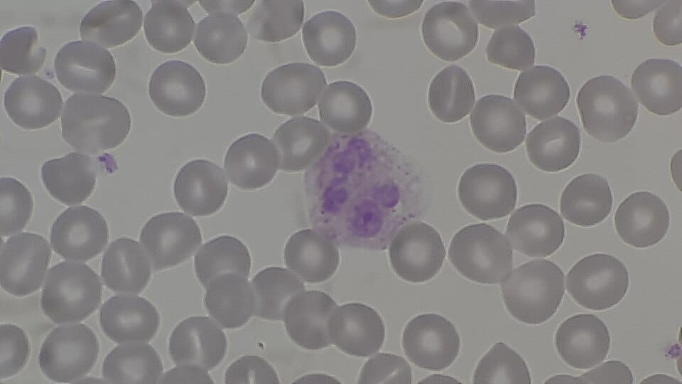 A photograph of a blood sample under a microscope. On a pale grey background are many grey ovals with pale centres which are red blood cells. A larger fuzzy purple blob is white blood cells, and a few small purple flecks are platelets.