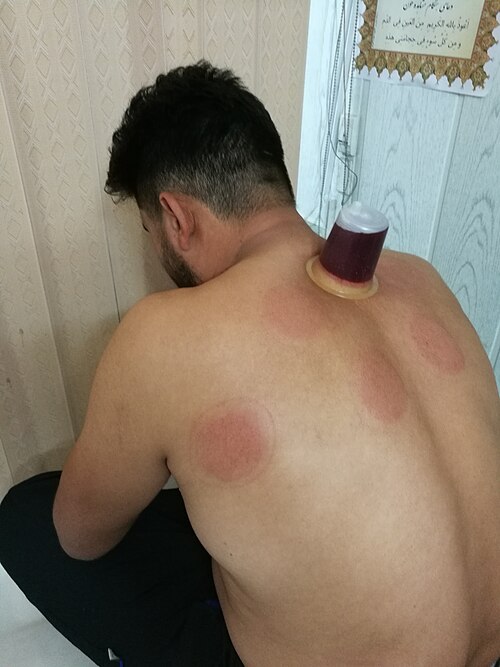 Photograph taken from behind a seated man, naked from the waist up. A clear cup is attached to his upper back with its mouth sealed against his skin. The cup is almost full of blood. Five circular marks are elsewhere on his back.